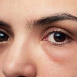 18 Tips to Get Rid of Dark Circles and Eye Bags