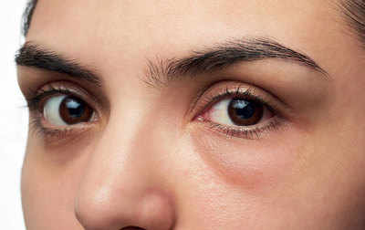 18 Tips to Get Rid of Dark Circles and Eye Bags