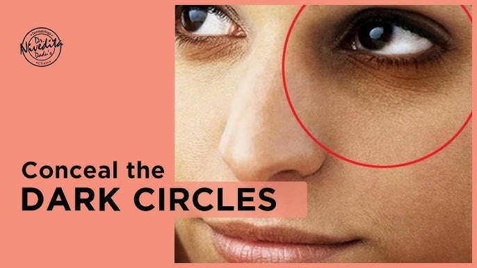 7 Reasons Why You Have Under-Eye Dark Circles