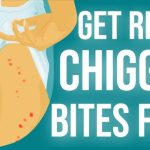 How To Get Rid Of Chigger Bites