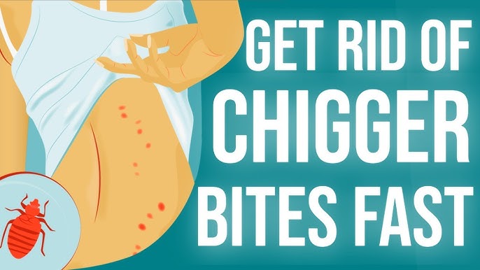 How To Get Rid Of Chigger Bites