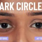 how to get rid of dark circles effectively