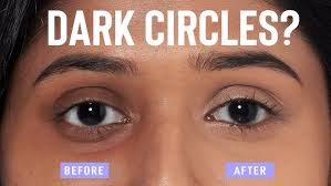 how to get rid of dark circles effectively