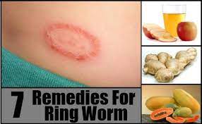 10 Best Natural Home Remedies For Ringworm Treatment