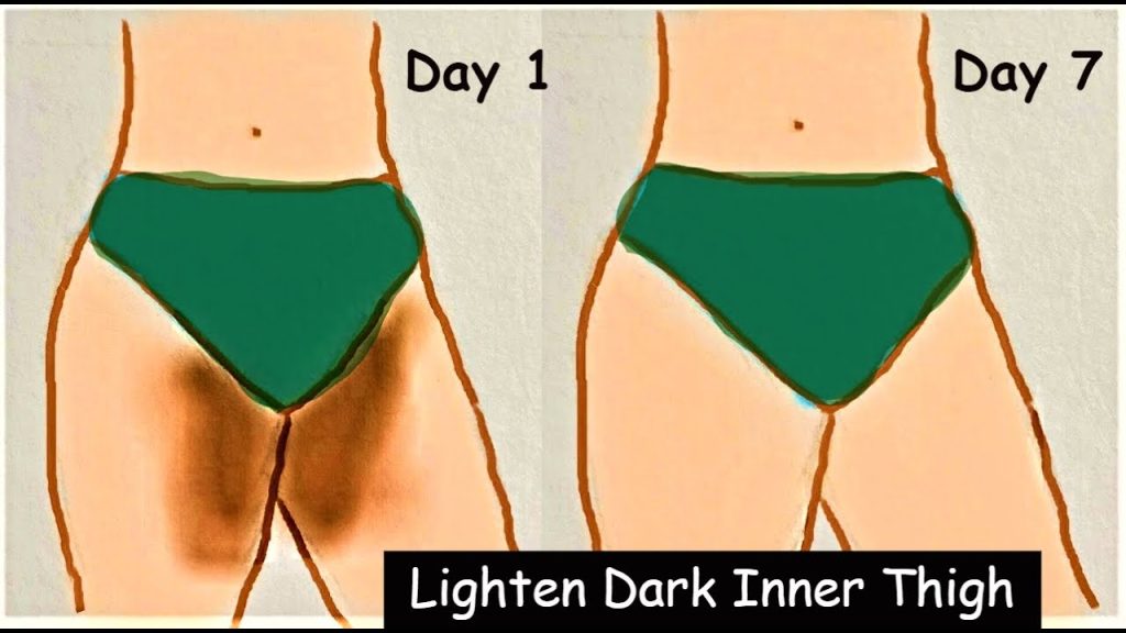 How To Lighten Dark Inner Thighs Naturally