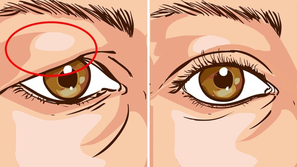 How To Lift Up Sagging Eyelids