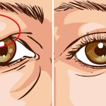 How To Lift Up Sagging Eyelids