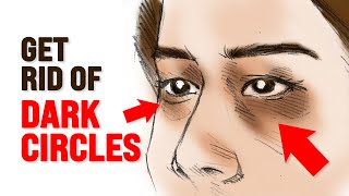 4 Common Types of Dark Circles and Tips To Remove Them Permanently