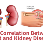 Understanding the Connection Between Gout and Kidney Stones