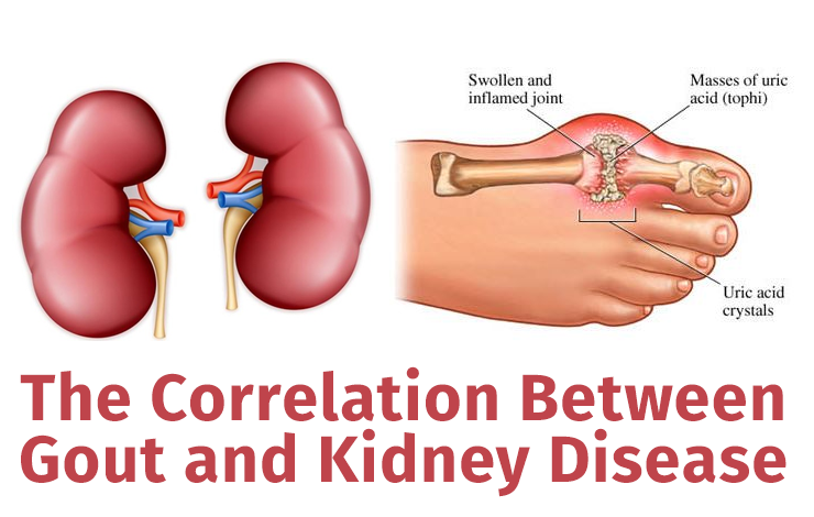 Understanding the Connection Between Gout and Kidney Stones