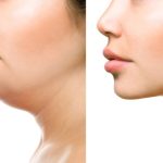 How to Get Rid of Neck Fat