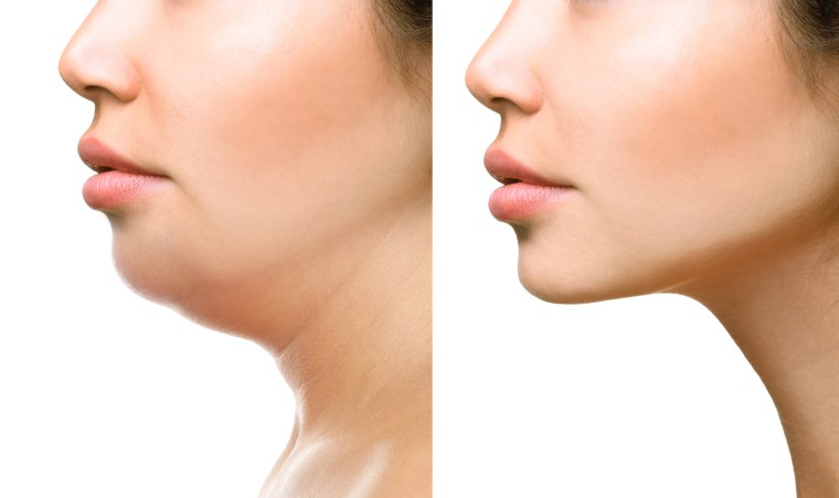 How to Get Rid of Neck Fat