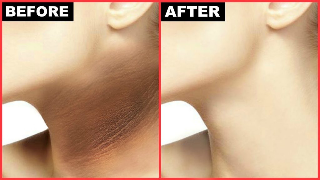 How to Get Rid of Dark Neck at Home: Top Natural Remedies